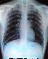 "Chest X-ray" by Aidan Jones "Chest X-ray" by Aidan Jones